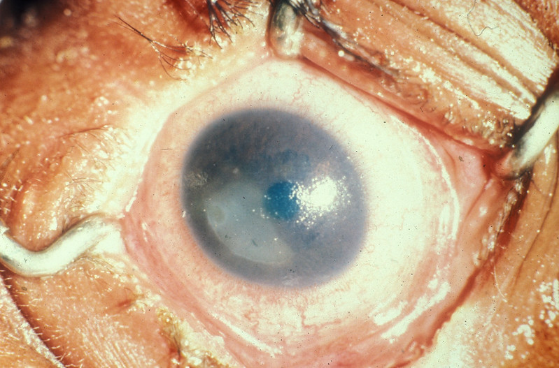 告別眼睛乾澀！「鞏膜鏡」原來可以治療乾眼症|Optact International 鷗 