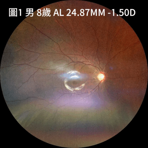近視控制－相近眼軸的眼底一樣嗎？